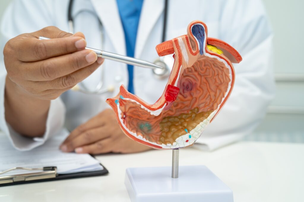 Stomach disease, doctor with human anatomy model for study diagnosis and treatment in hospital.